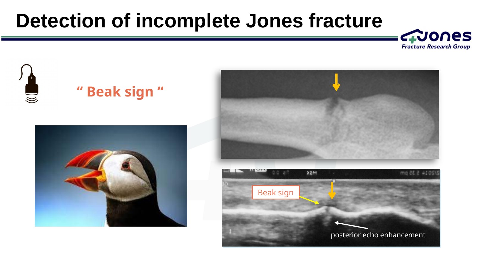 Beak sign