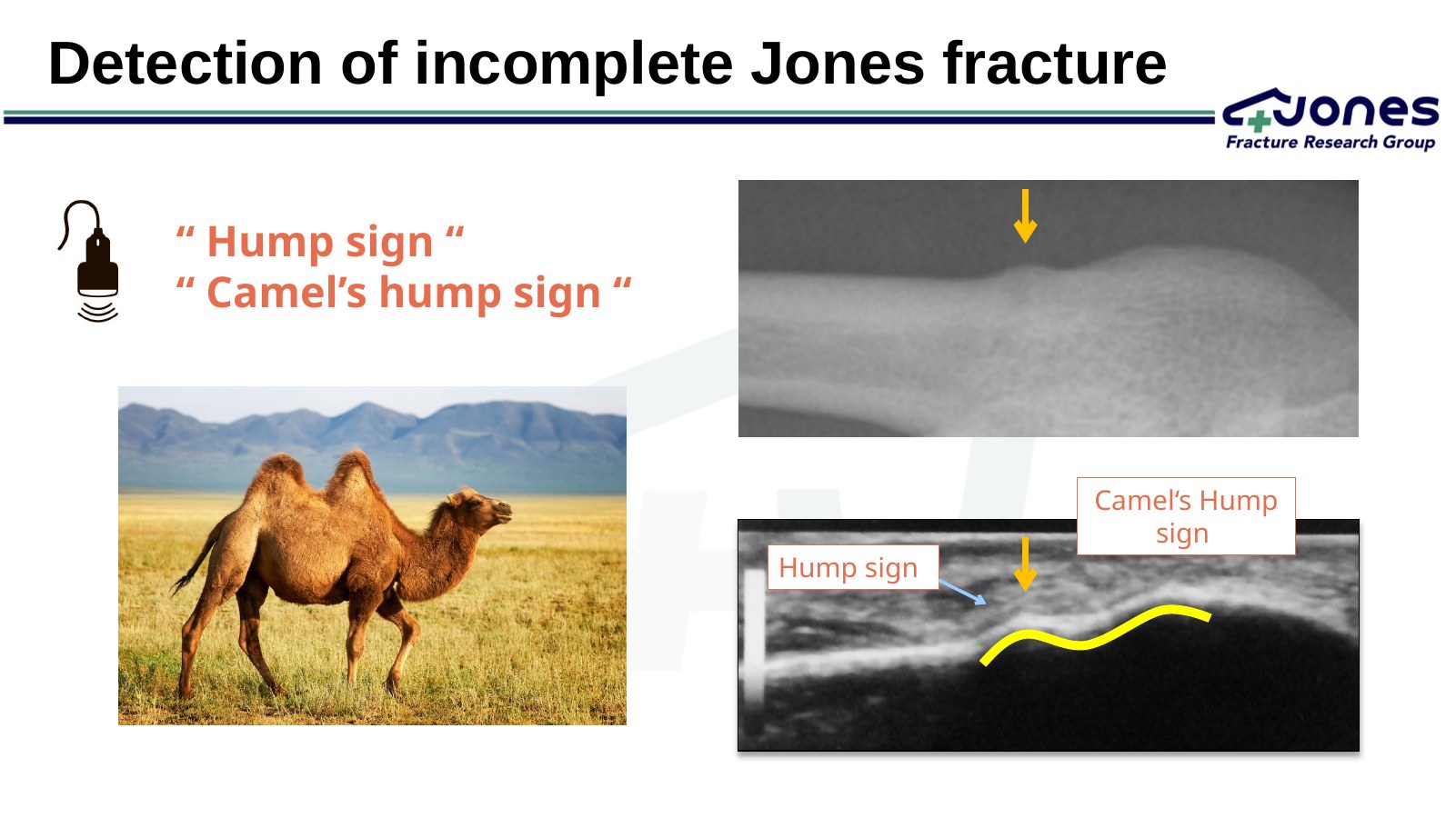 Hump sign / Camel's hump sign