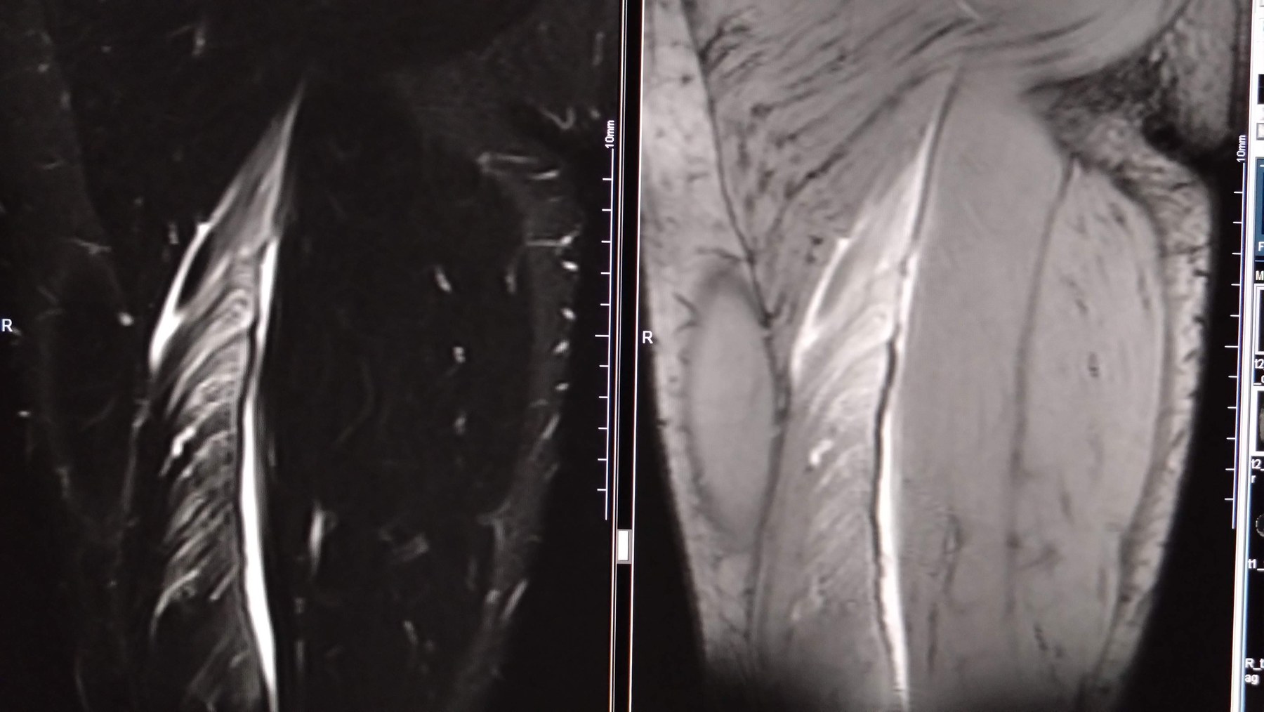 筋内腱損傷を伴うハムストリング損傷のMRI