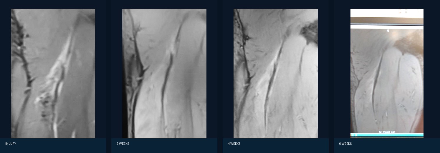 PRP and regenerative orthopaedics