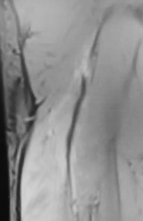 受傷2週のMRI