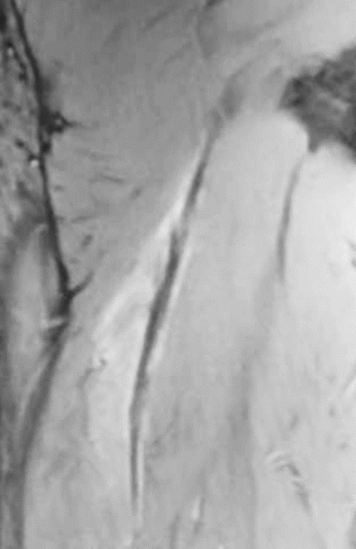 受傷4週のMRI