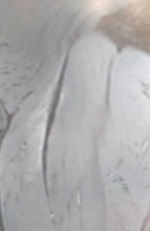 受傷6週のMRI
