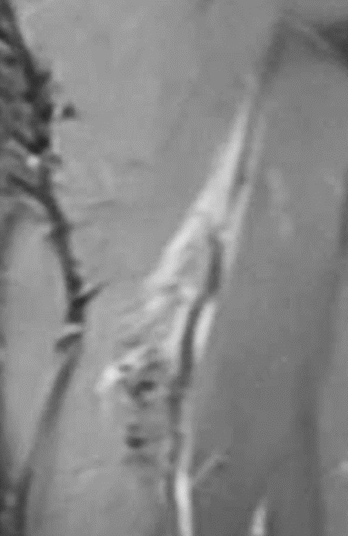 受傷時のMRI